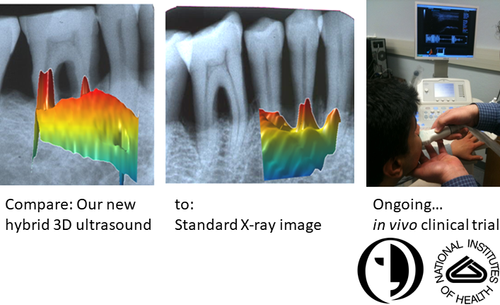 3D ultrasound for periodontitis diagnostic